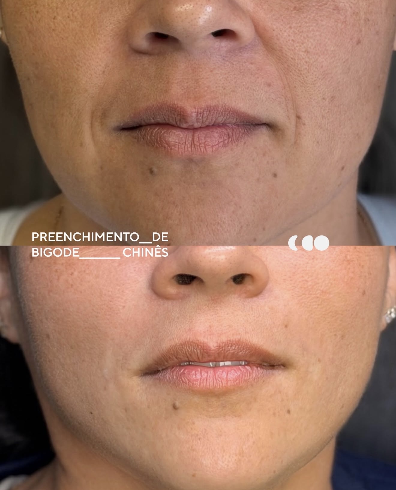 Antes (em cima) e depois (embaixo) — bigode chinês (sulco nasogeniano)