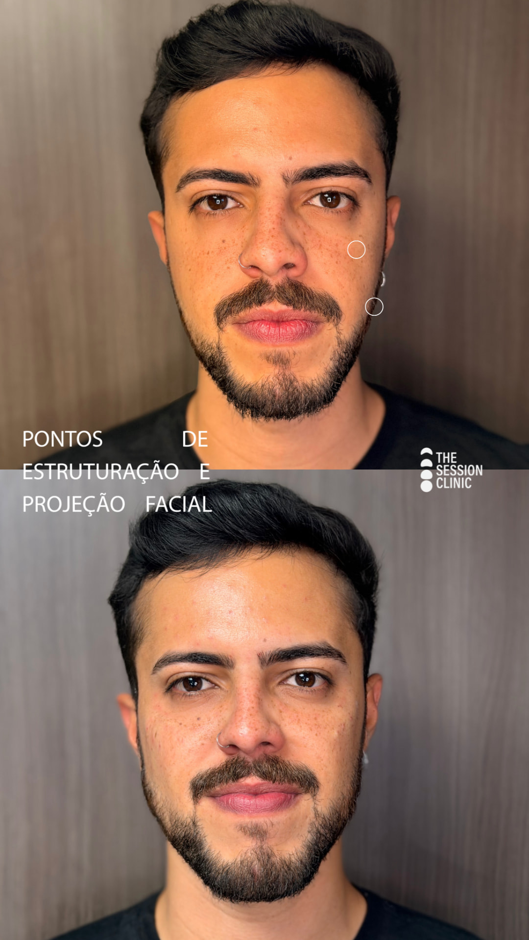 Antes e depois — full face (estruturação e projeção facial)