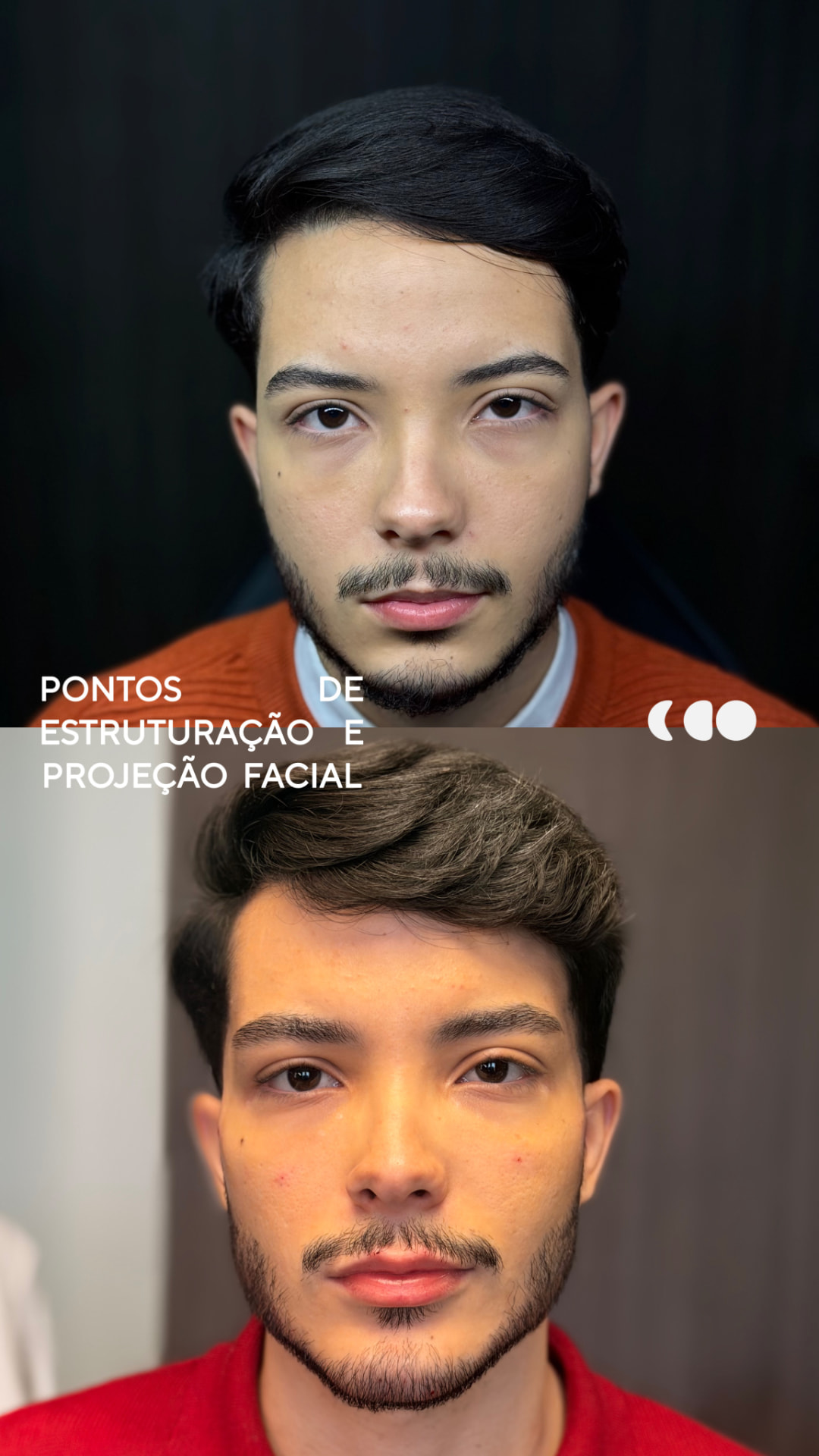 Antes e depois — full face (estruturação e projeção facial)