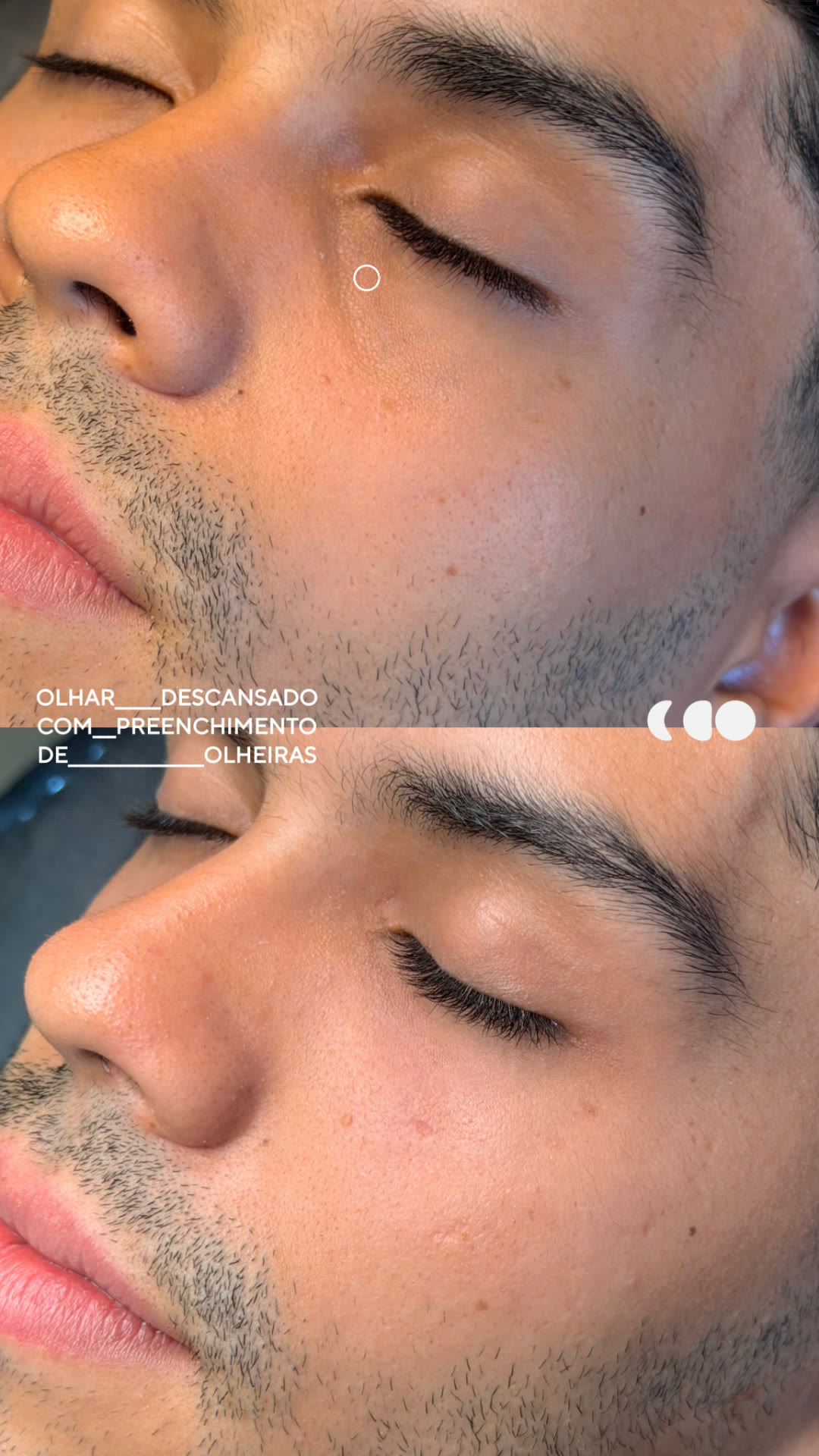 Antes (em cima) e depois (embaixo) — olheiras
